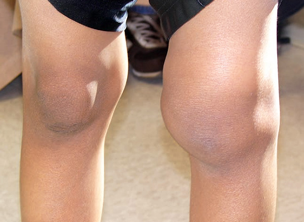 ผลที่ตามมาของโรคข้ออักเสบที่เกิดจาก Lyme borreliosis