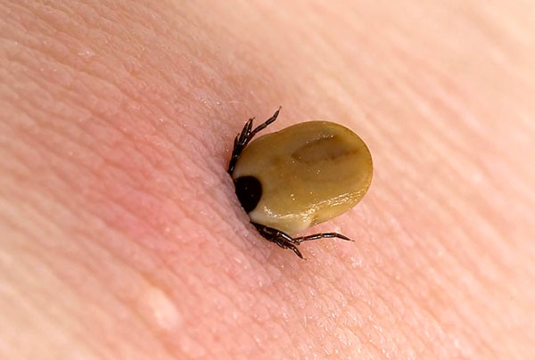 Infezione dopo una puntura di zecca