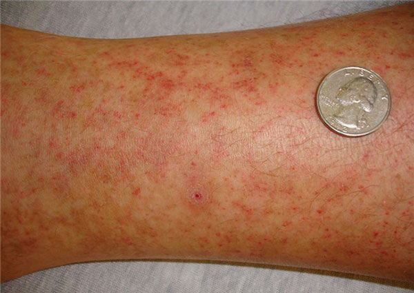 Eruzioni sul corpo della febbre maculata delle Montagne Rocciose