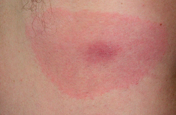 Eritema na doença de Lyme
