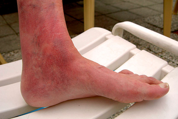 Danos articulares na borreliose crônica